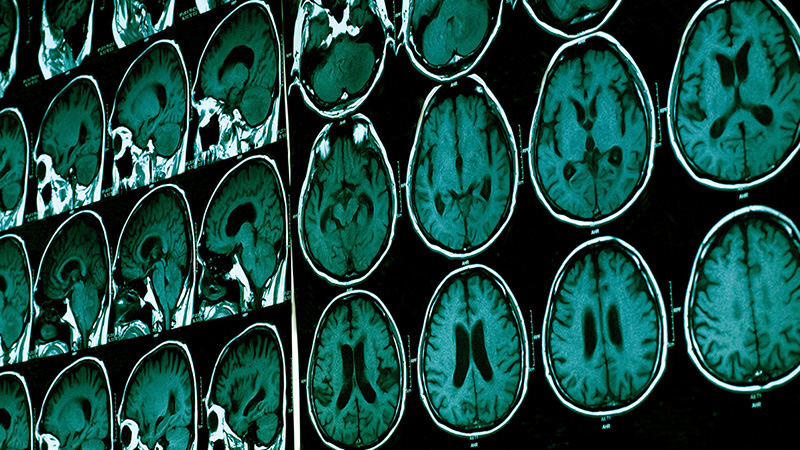 CT scans of brains with a teal tint