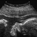 an ultrasound picture of prenatal baby