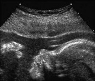 an ultrasound picture of prenatal baby